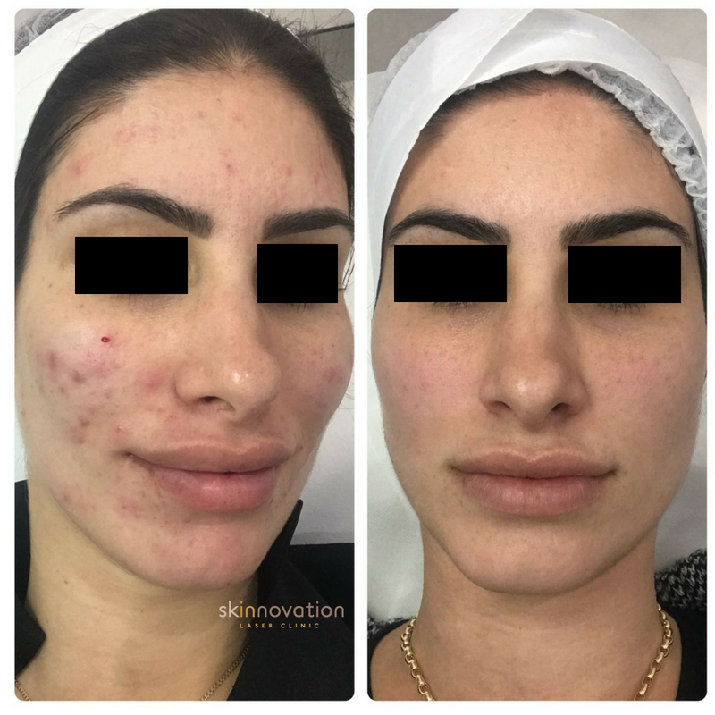 Clear Skin Laser Treatment, Sydney Cosmetic Laser