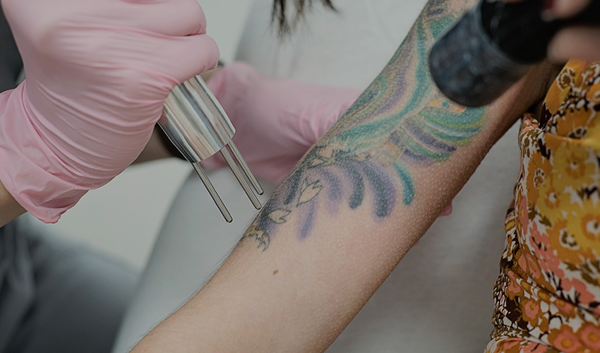 Best Laser Tattoo Removal Randwick | Skinnovation Laser Clinic
