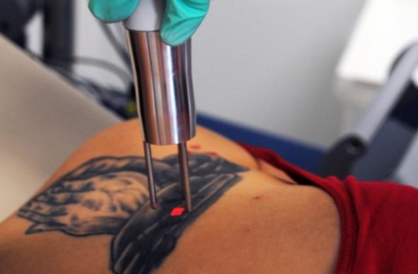 Tattoo Removal Laser  Dr Kamil Al Rustom Skin  Laser Centre