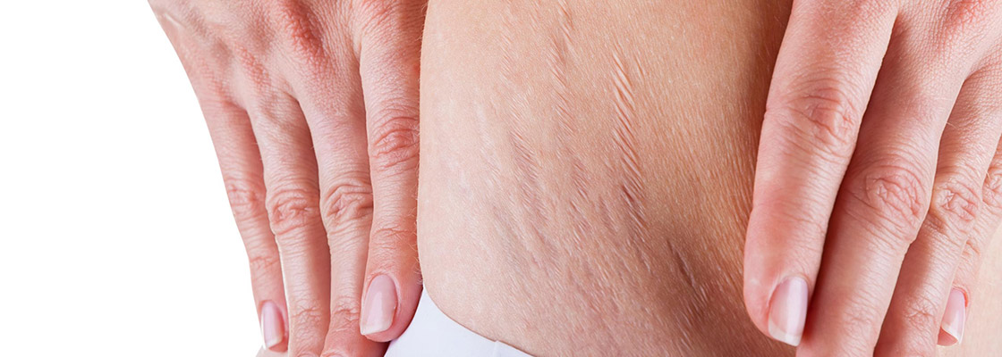 Stretch Mark Removal & Stretch Marks Treatment Sydney