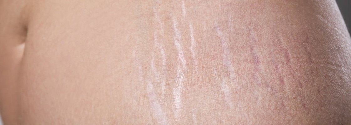 Stretch Mark Removal & Treatment Sydney