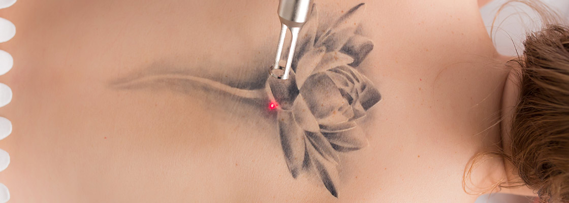 Before & After Tattoo Removal Photos - The Ultimate Guide