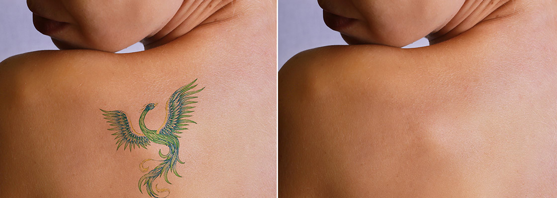 Laser Tattoo Removal Sydney | Best Tattoo Removal Treatment in Sydney