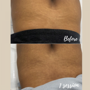 Stretch Mark Removal & Stretch Marks Treatment Sydney