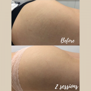 Stretch Mark Removal & Treatment Sydney