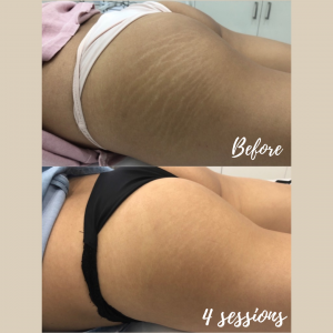 Answering the Common Questions About Stretch Marks